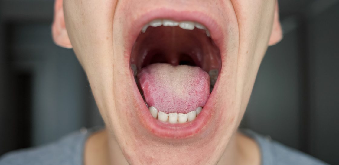 What should your tonsils look like?