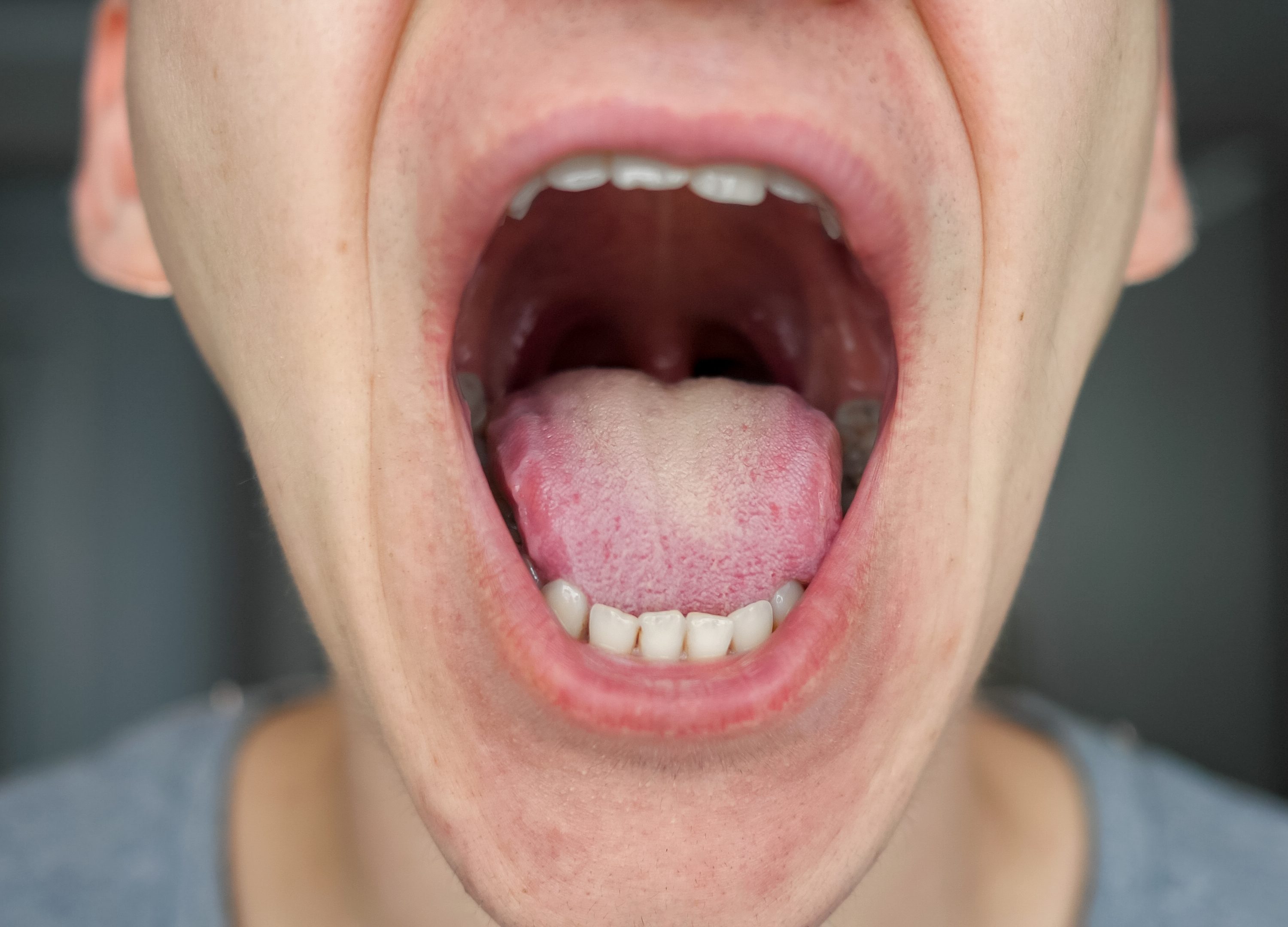 What Do White Spots On Tonsils Look Like